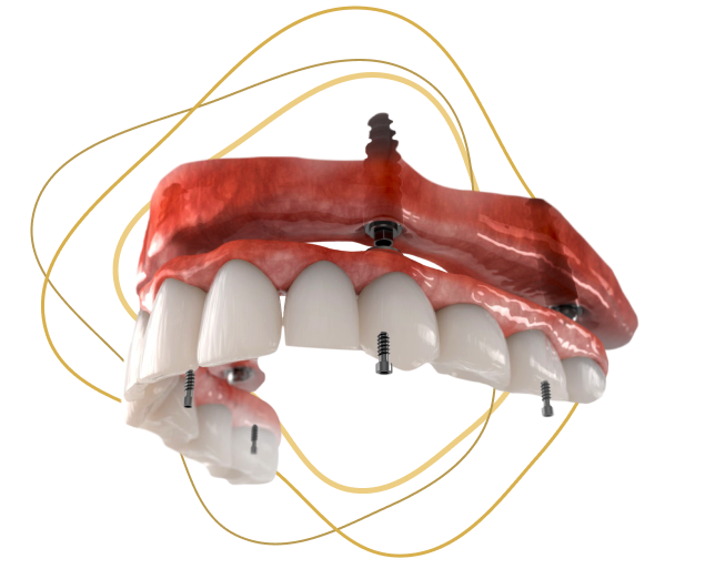 adent jaw all-on-4