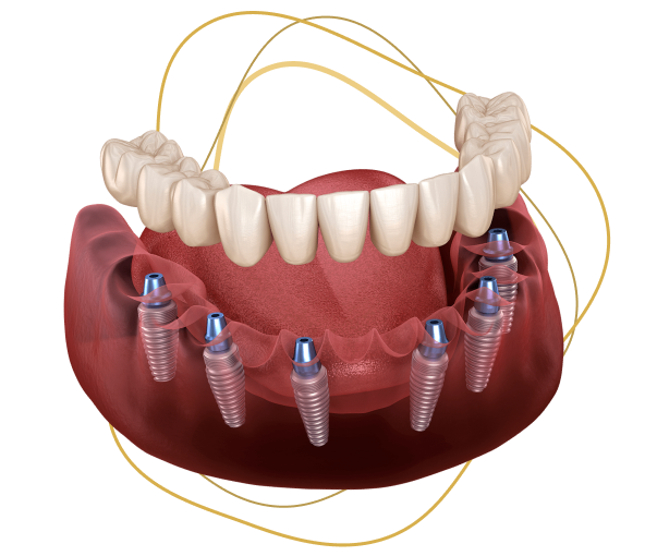 adent jaw all-on-6