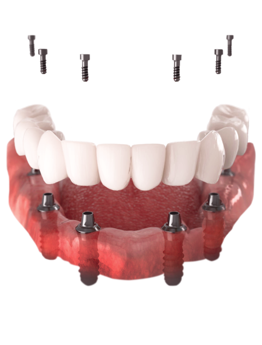 adent jaw