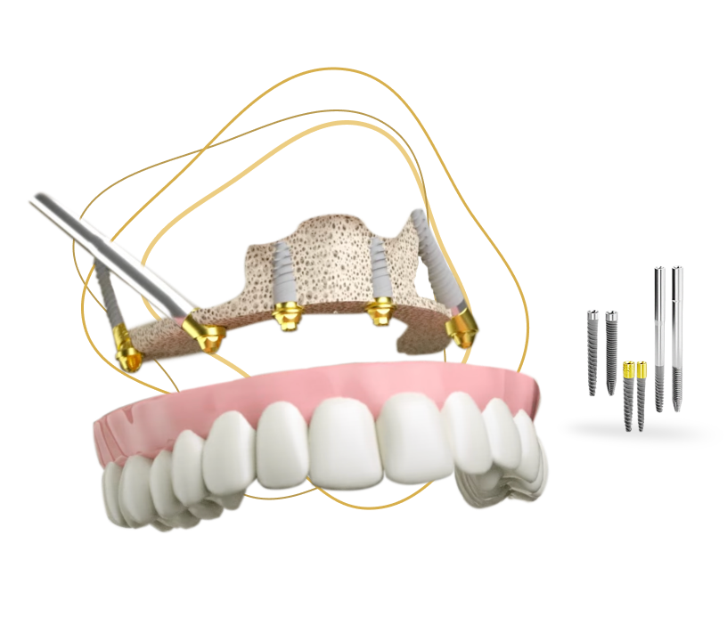 adent jaw with implant